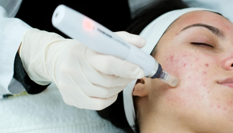Clear Acne with Advanced Laser Treatments