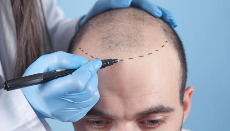 Restore Hair Loss with the Best Permanent Hair Transplant