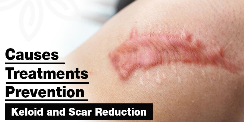 Keloid and Scar Reduction