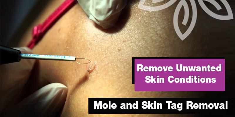 Mole and Skin Tag Removal